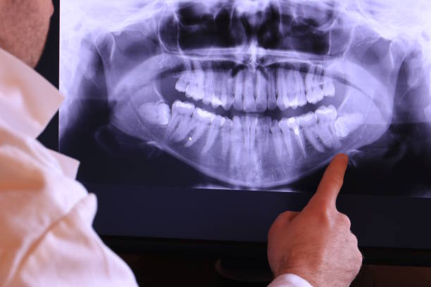 Best Emergency Wisdom Teeth Removal in Ross, OH